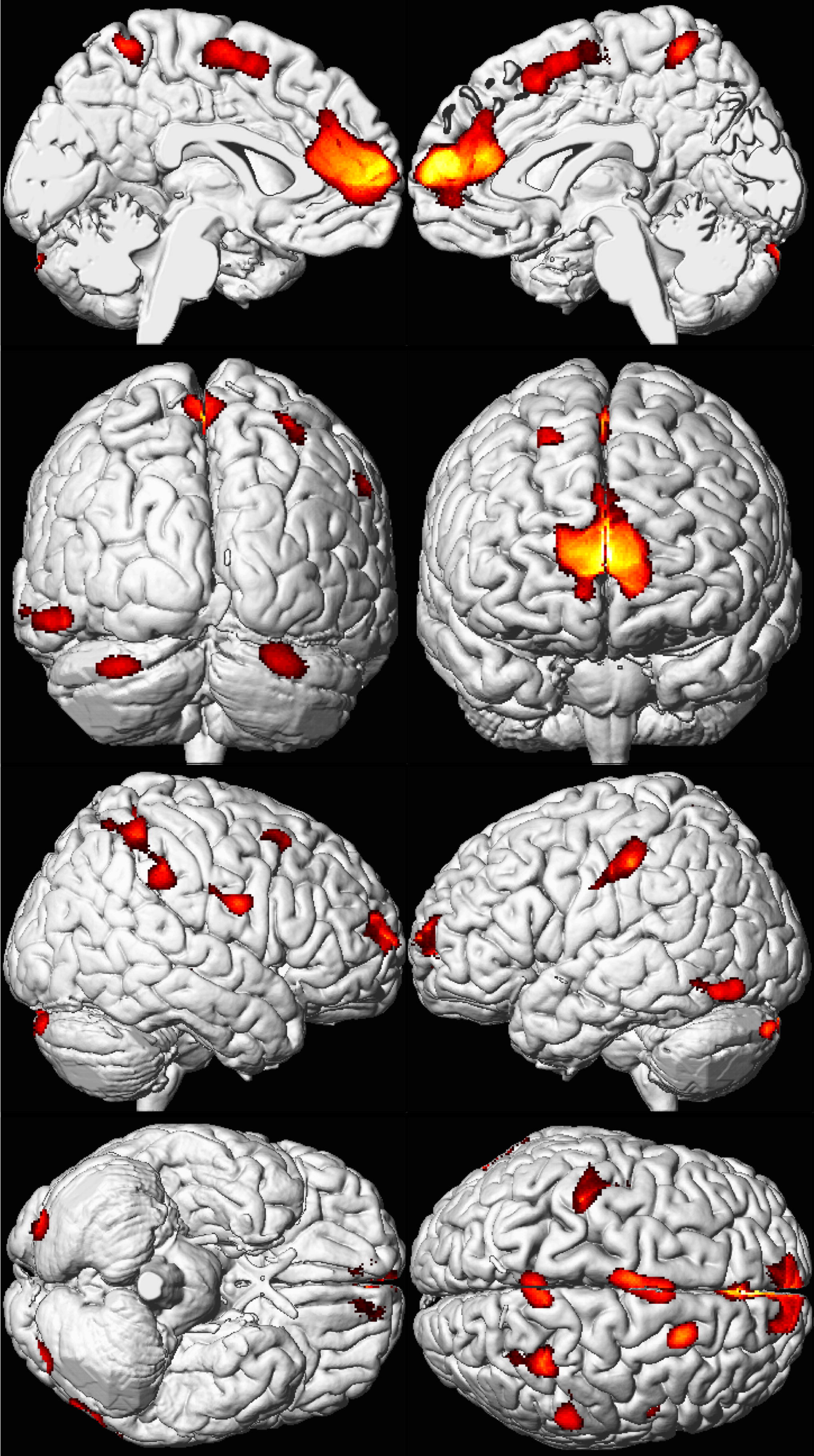 MRI scans demonstrating decreased brain volume, particularly in the prefrontal cortex, in adults exposed to lead as children. This severe neurological impact is the primary driver behind strict Massachusetts lead paint regulations.