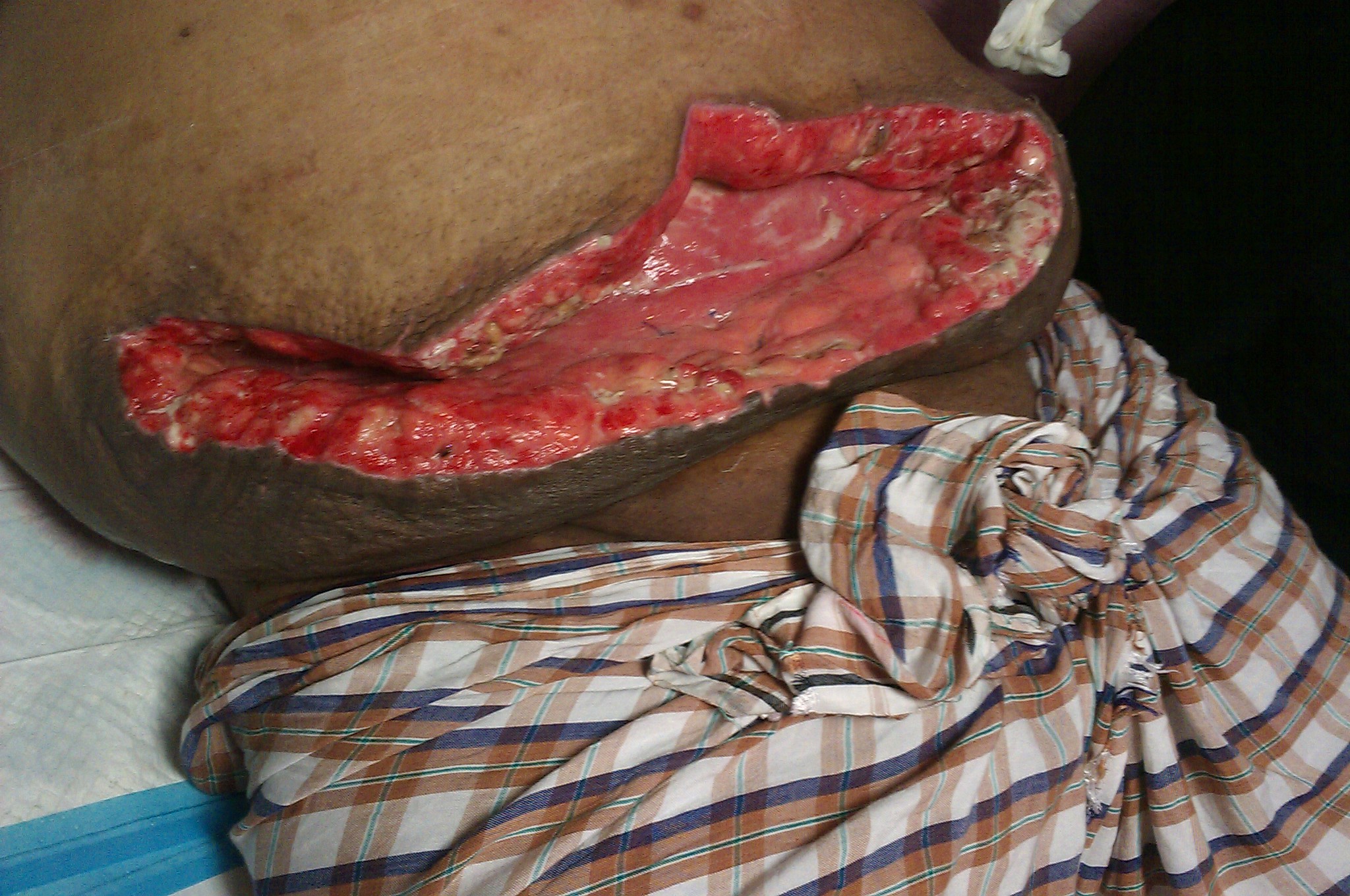 Wound dehiscence, characterized by the partial or complete separation of the outer layers of a surgical incision.