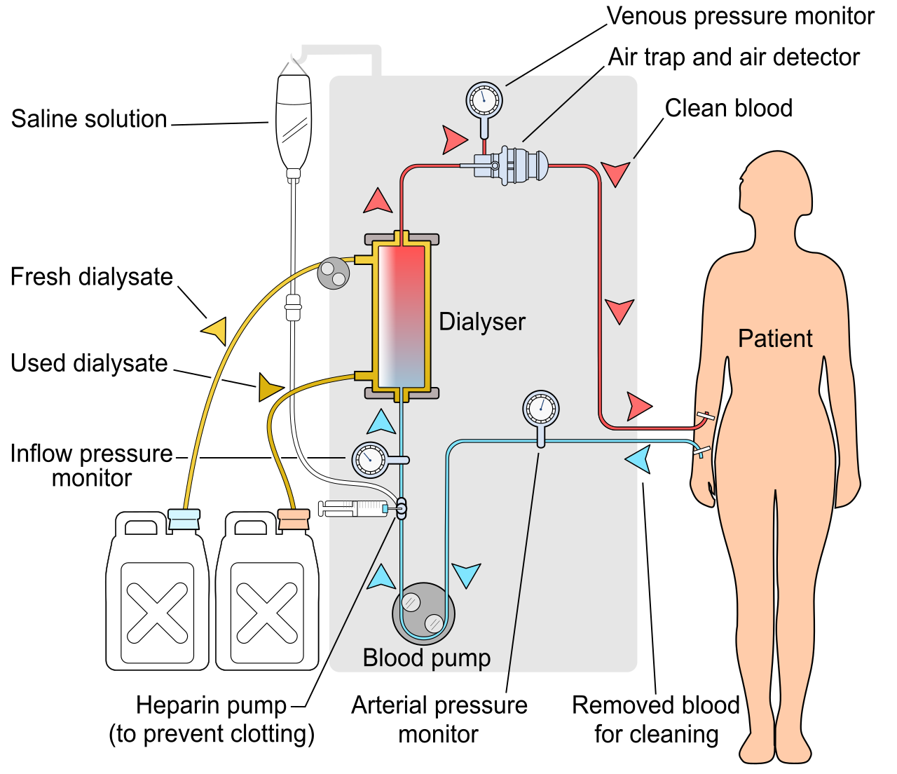 Schematic of a hemodialysis circuit, showing how blood is drawn, passed through a semipermeable dialyzer to remove waste and fluid via diffusion and ultrafiltration, and returned to the patient.