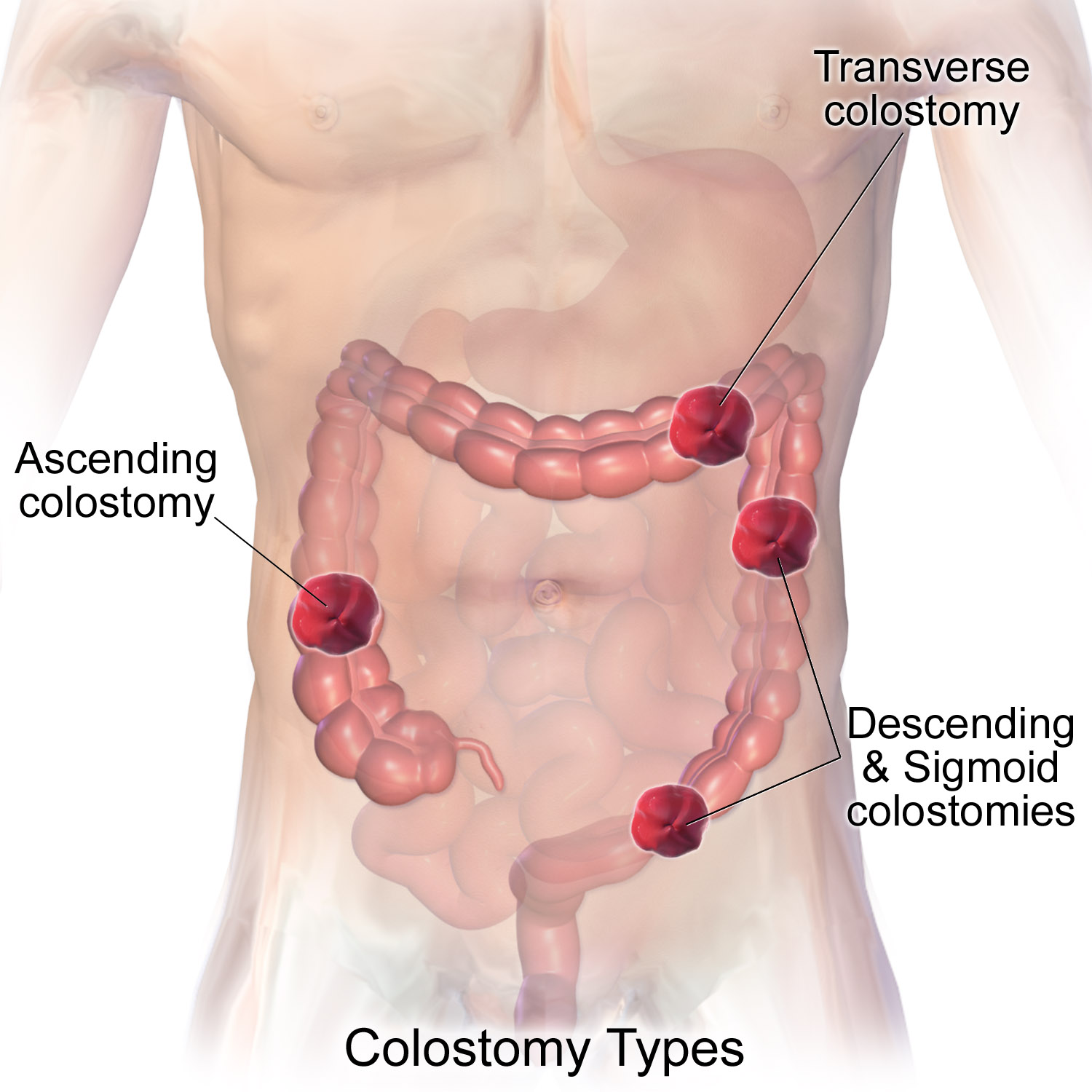 Diagram illustrating different locations for a colostomy; regardless of placement, a healthy stoma must always appear moist and beefy red, indicating excellent blood perfusion.