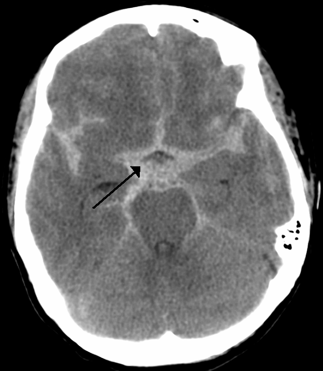 A CT scan demonstrating a subarachnoid hemorrhage. As excess fluid accumulates in the rigid cranial vault, intracranial pressure rises, eventually crushing the brainstem and triggering Cushing's triad.