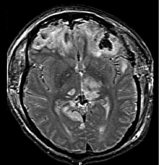 MRI scan demonstrating brain herniation caused by uncompensated increases in intracranial volume and pressure within the rigid skull vault.