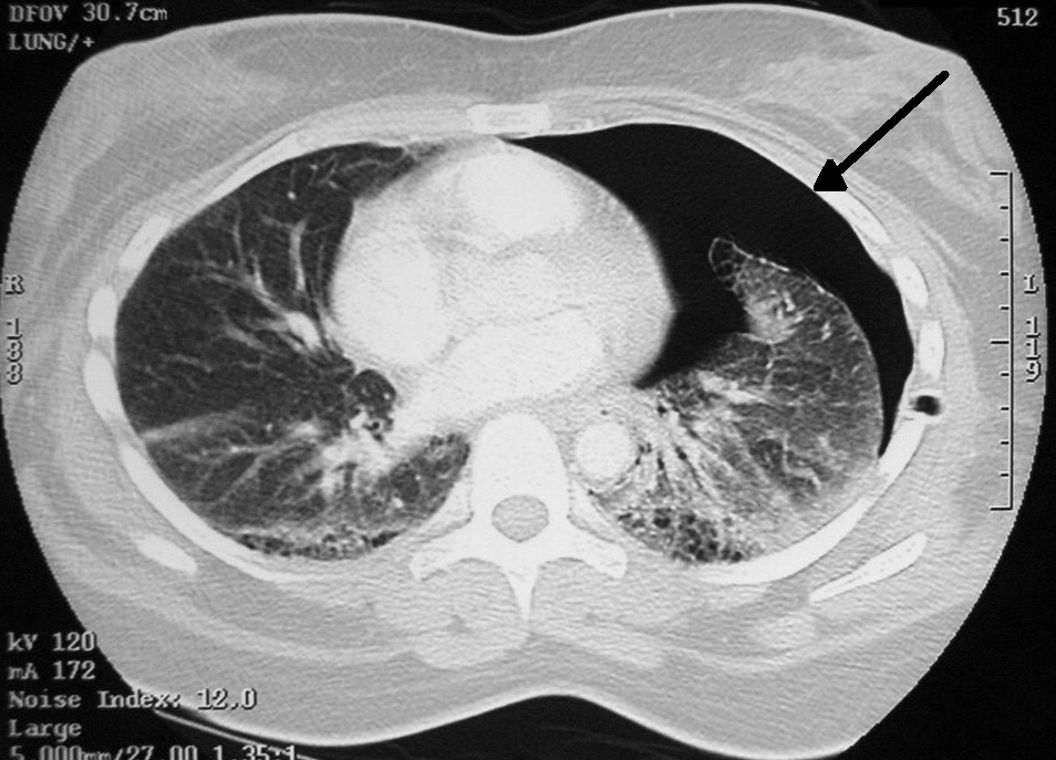 A CT scan revealing a right-sided pneumothorax (visible as the dark area on the left of the image). This is a critical complication that can occur if the pleural space is inadvertently punctured during a subclavian central line insertion.