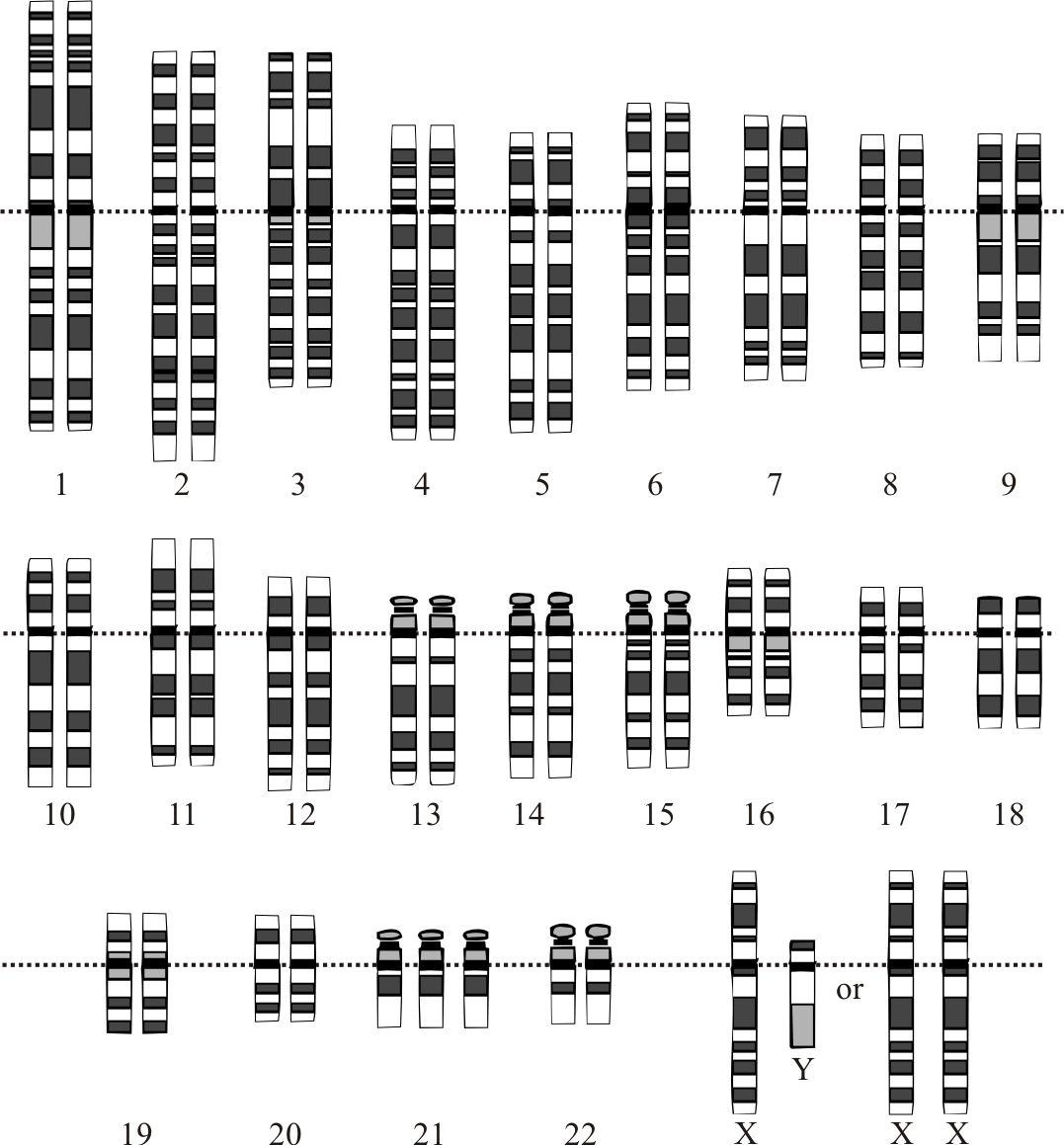 Down syndrome is a genetic condition caused by a chromosomal abnormality, specifically the presence of a third copy of chromosome 21, as seen in this karyotype.