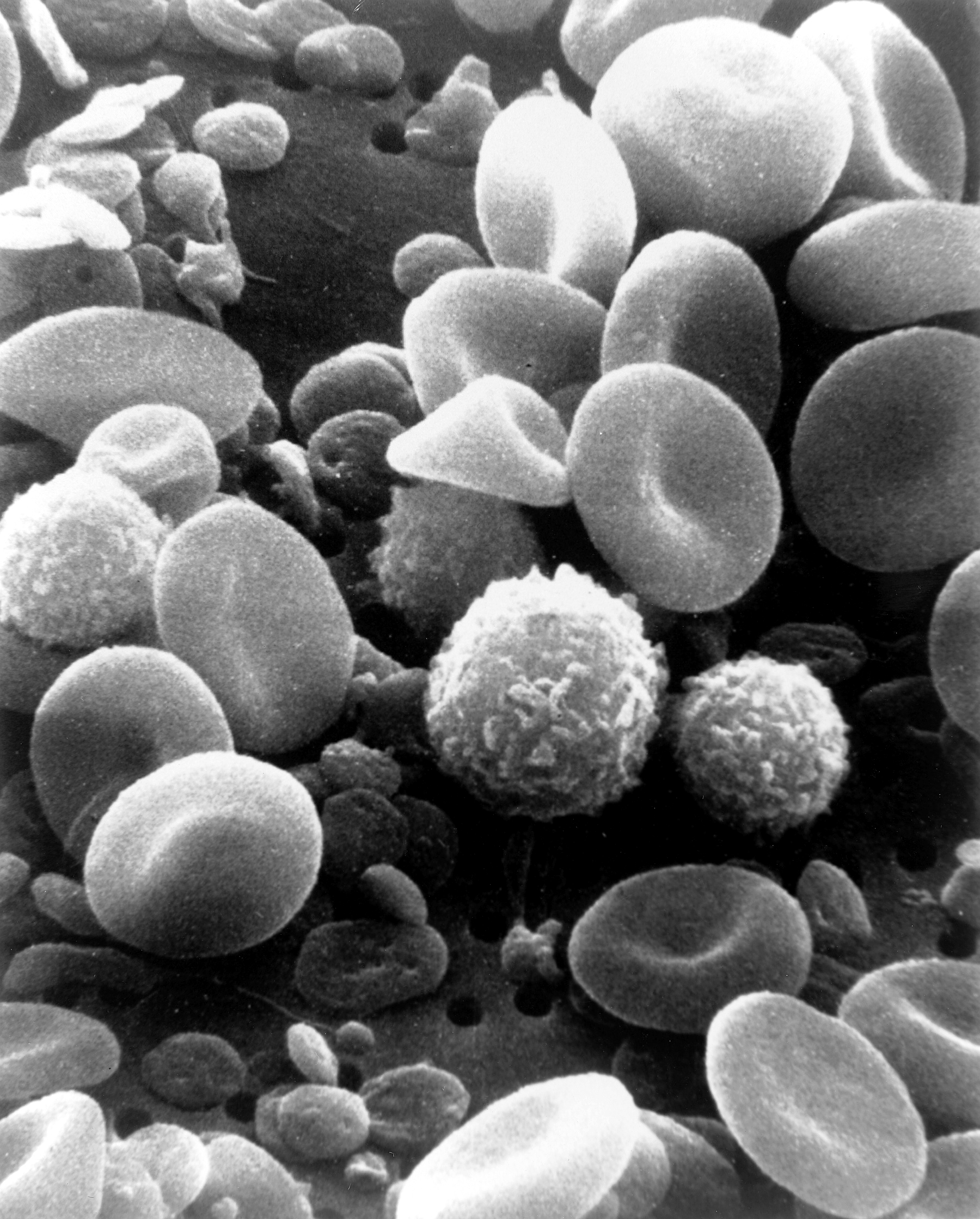 Scanning electron microscope image of normal circulating blood cells. In conditions of chronic hypoxia, the body's compensatory overproduction of red blood cells leads to the thick, viscous blood characteristic of polycythemia.