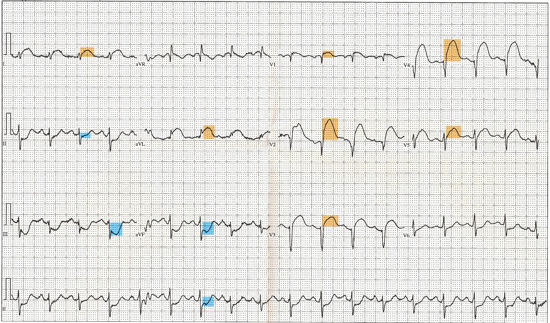 A 12-lead electrocardiogram demonstrating ST-segment elevation, an urgent clinical sign indicating acute myocardial injury.