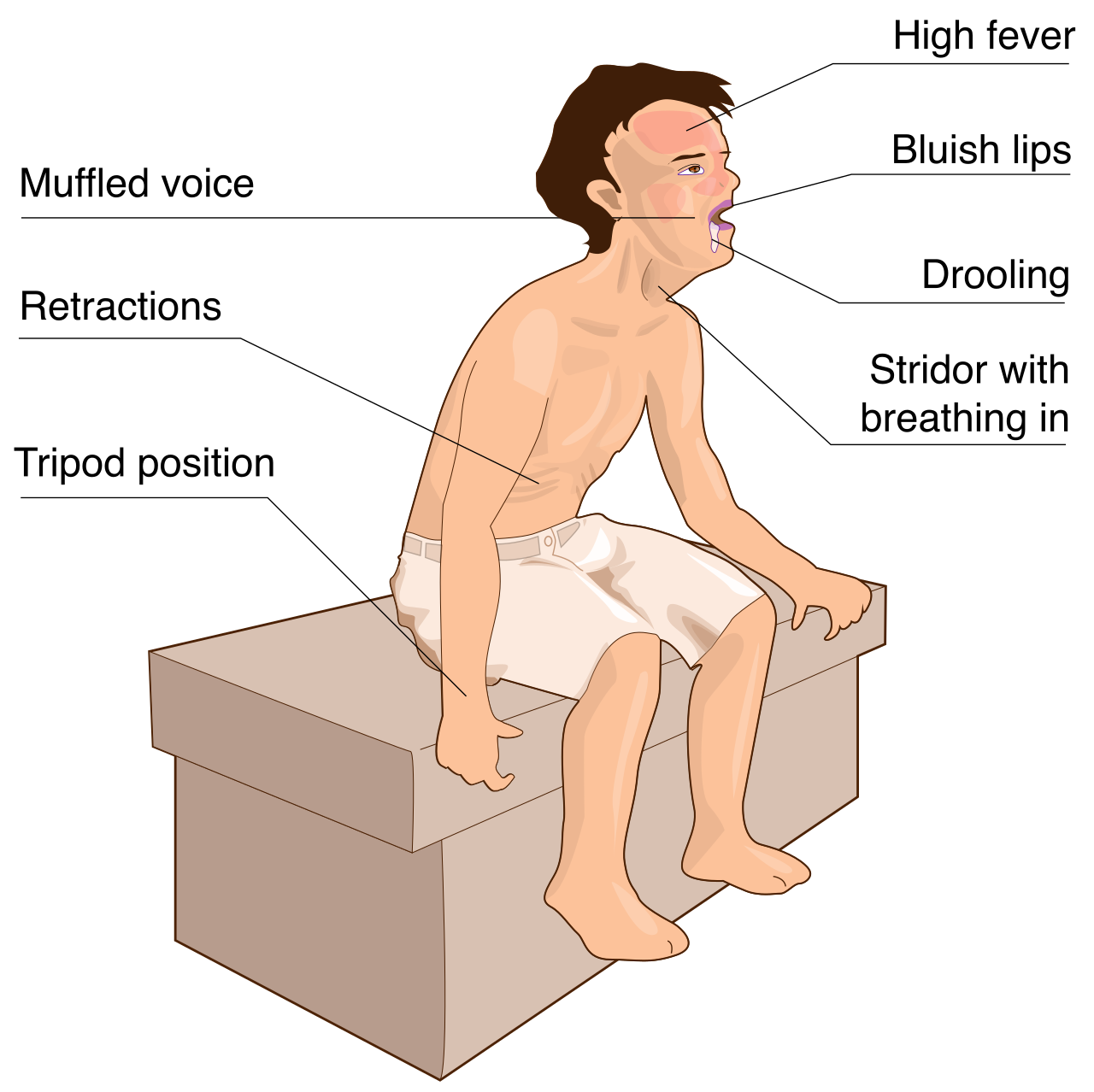 A child instinctively assuming the tripod position. This is a vital clinical sign of severe respiratory distress and a classic mechanical adaptation used by pediatric patients with epiglottitis to keep their airway open.