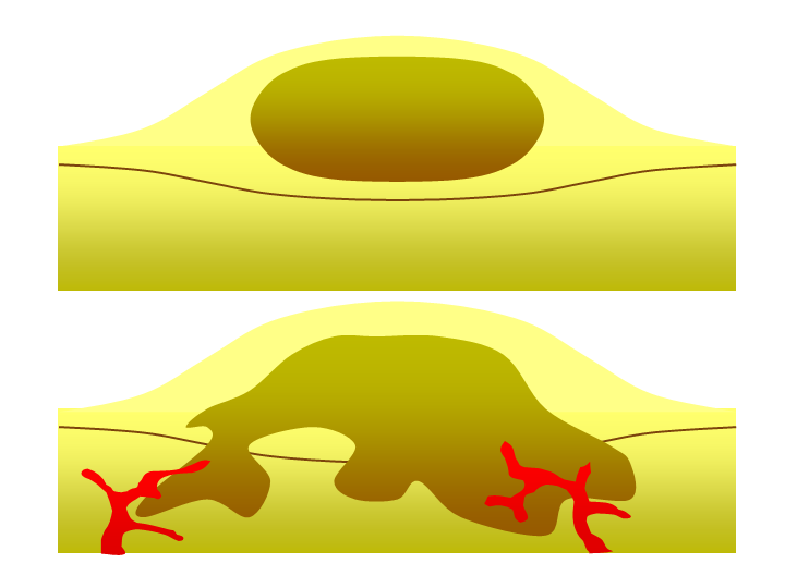 The suffix "-oma" indicates an abnormal growth or tumor, distinguishing conditions like a localized benign tumor from an invasive malignant tumor.