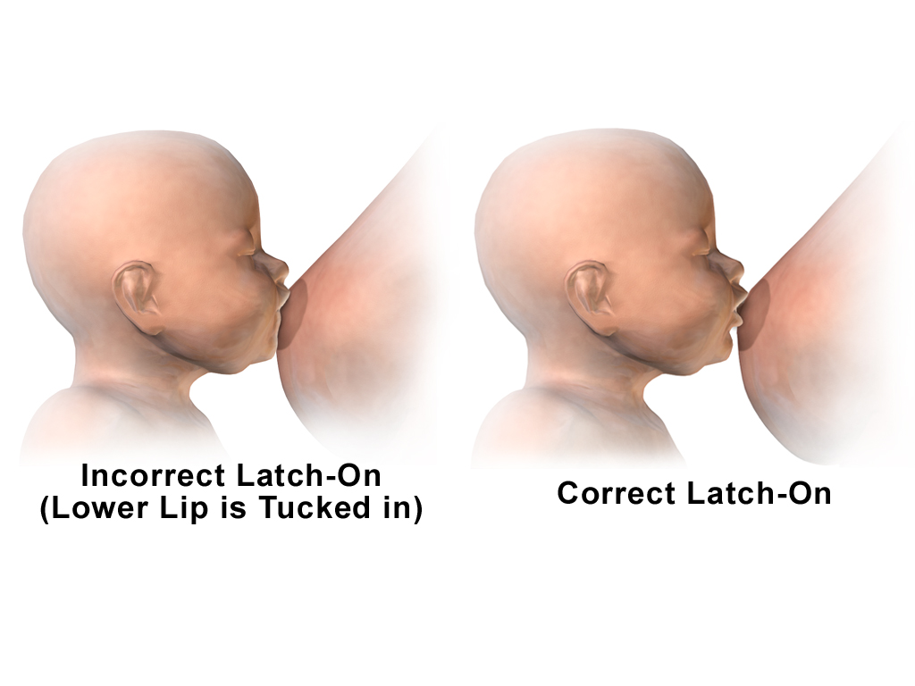 A correct breastfeeding latch compared to an incorrect one, highlighting how the infant's lips must flange outward to create a proper vacuum seal around the entire areola.