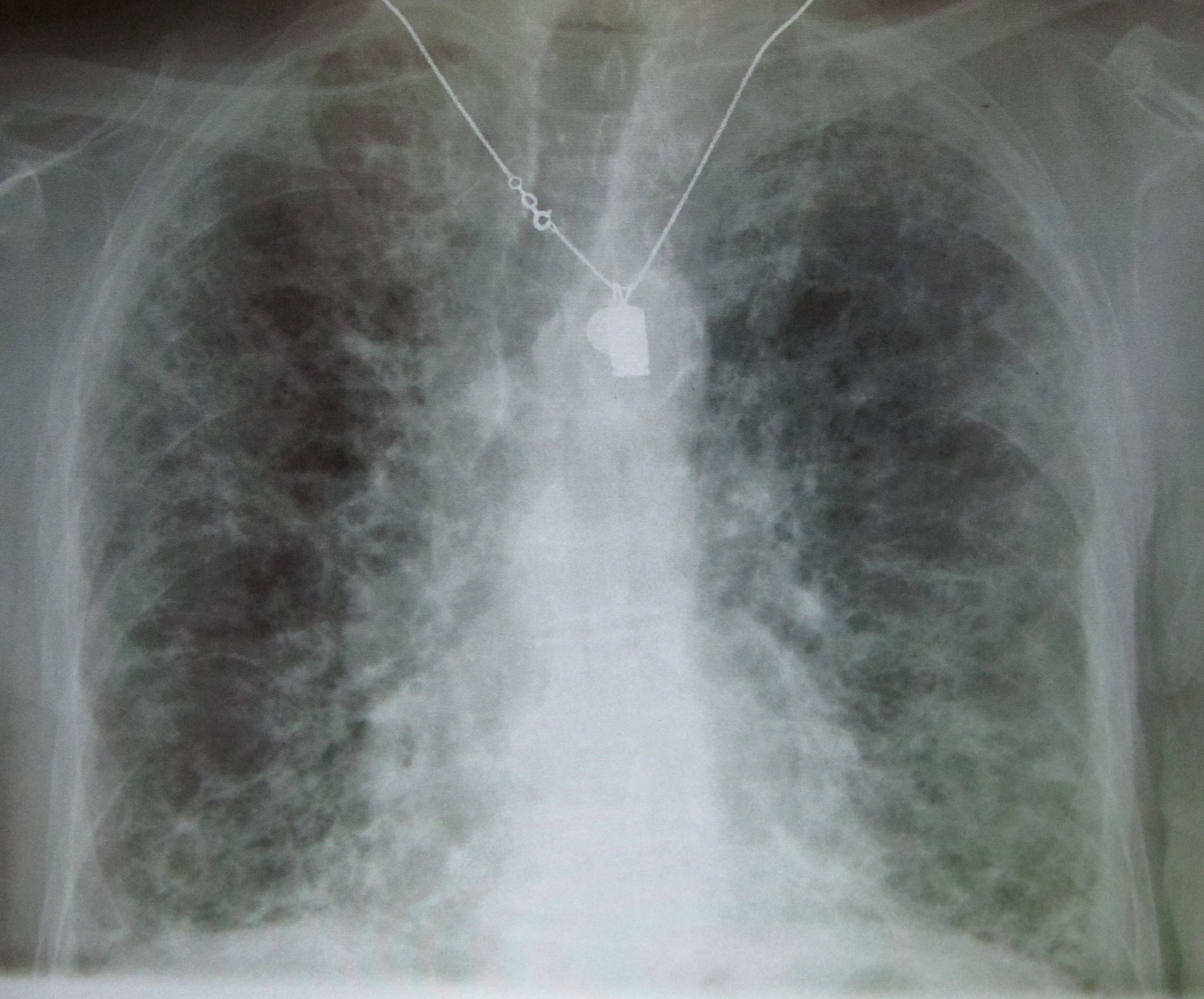 A chest X-ray demonstrating pulmonary fibrosis caused by amiodarone toxicity, one of the most severe adverse effects of this antiarrhythmic drug.