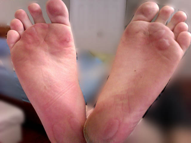 Friction blisters on the human foot. Clients with peripheral neuropathy cannot feel such injuries, necessitating daily visual foot inspections by the nurse to prevent severe limb-threatening complications.