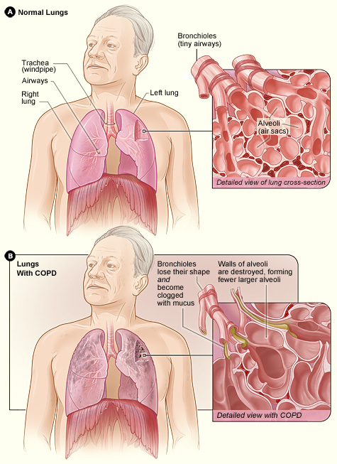 During SBAR communication for a patient with a COPD exacerbation, the clinical assessment may reveal diminished breath sounds due to chronically blocked bronchioles and damaged alveoli.