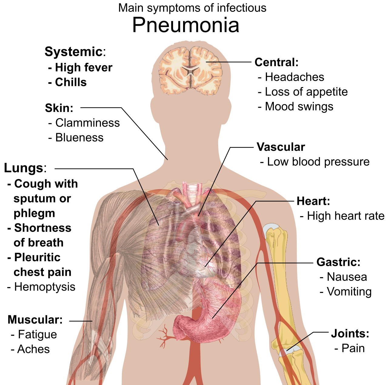 An implied main idea requires diagnostic synthesis. Individual symptoms like fever, cough, and chest pain serve as supporting details that collectively point to a single diagnostic conclusion—pneumonia.