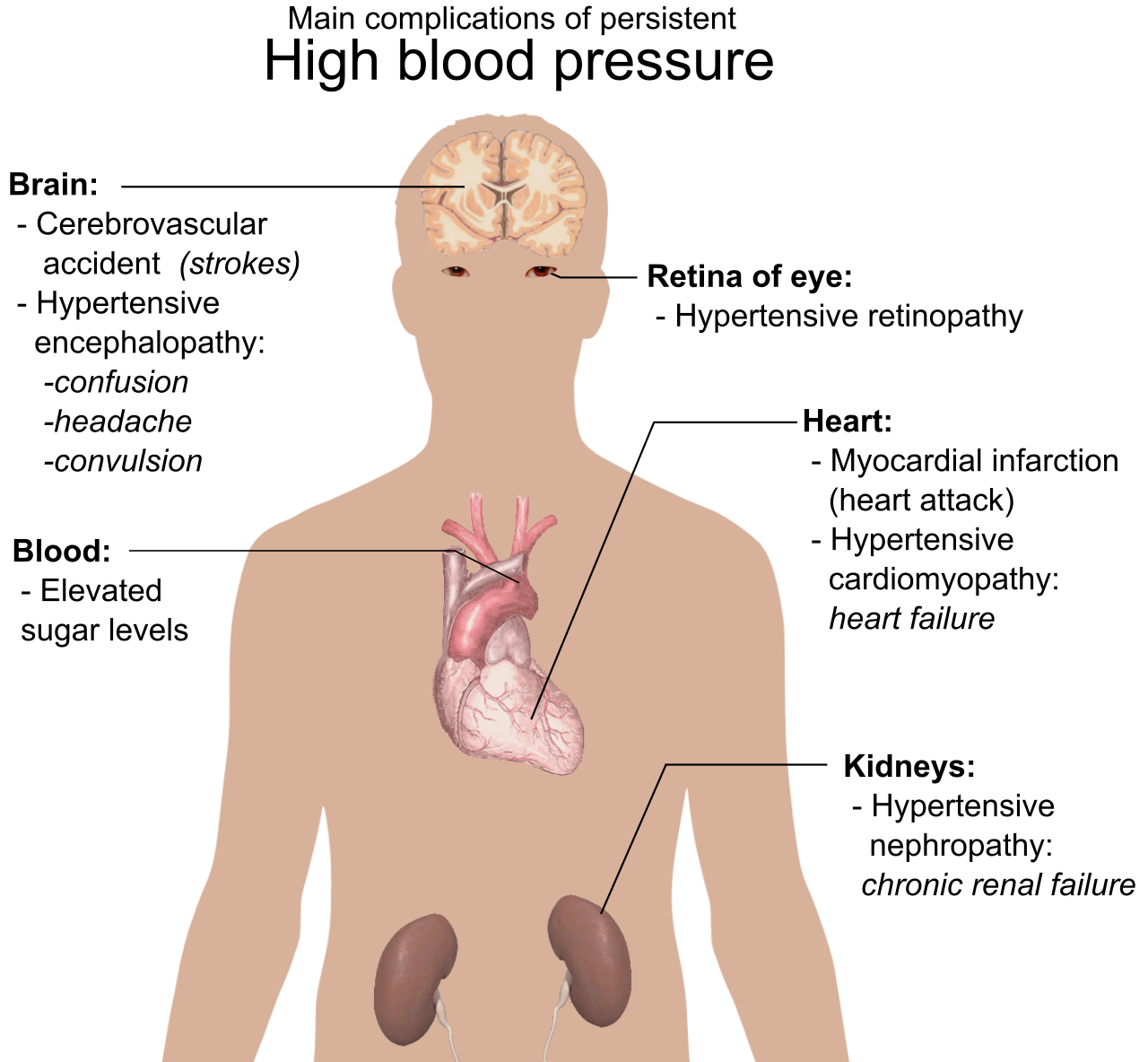 Systemic complications of persistent high blood pressure. In preeclampsia, severe hypertension can lead to widespread vascular and organ damage, culminating in seizures.
