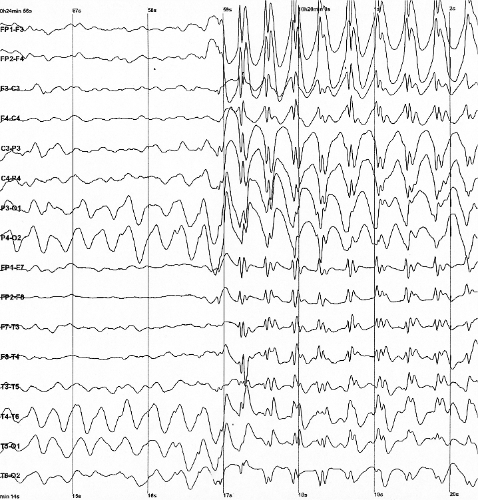 An EEG recording of an epileptic seizure demonstrating abnormal brain electrical activity, a condition that frequently co-occurs with the structural brain variances found in Cerebral Palsy.