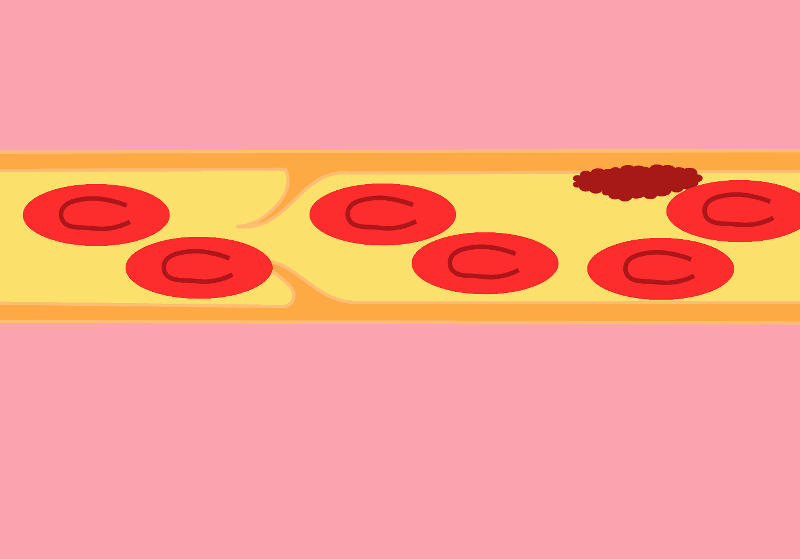 When blood stagnates or backs up in a line, a thrombus can form. Forcing a flush against resistance can dislodge this clot directly into the patient's bloodstream.