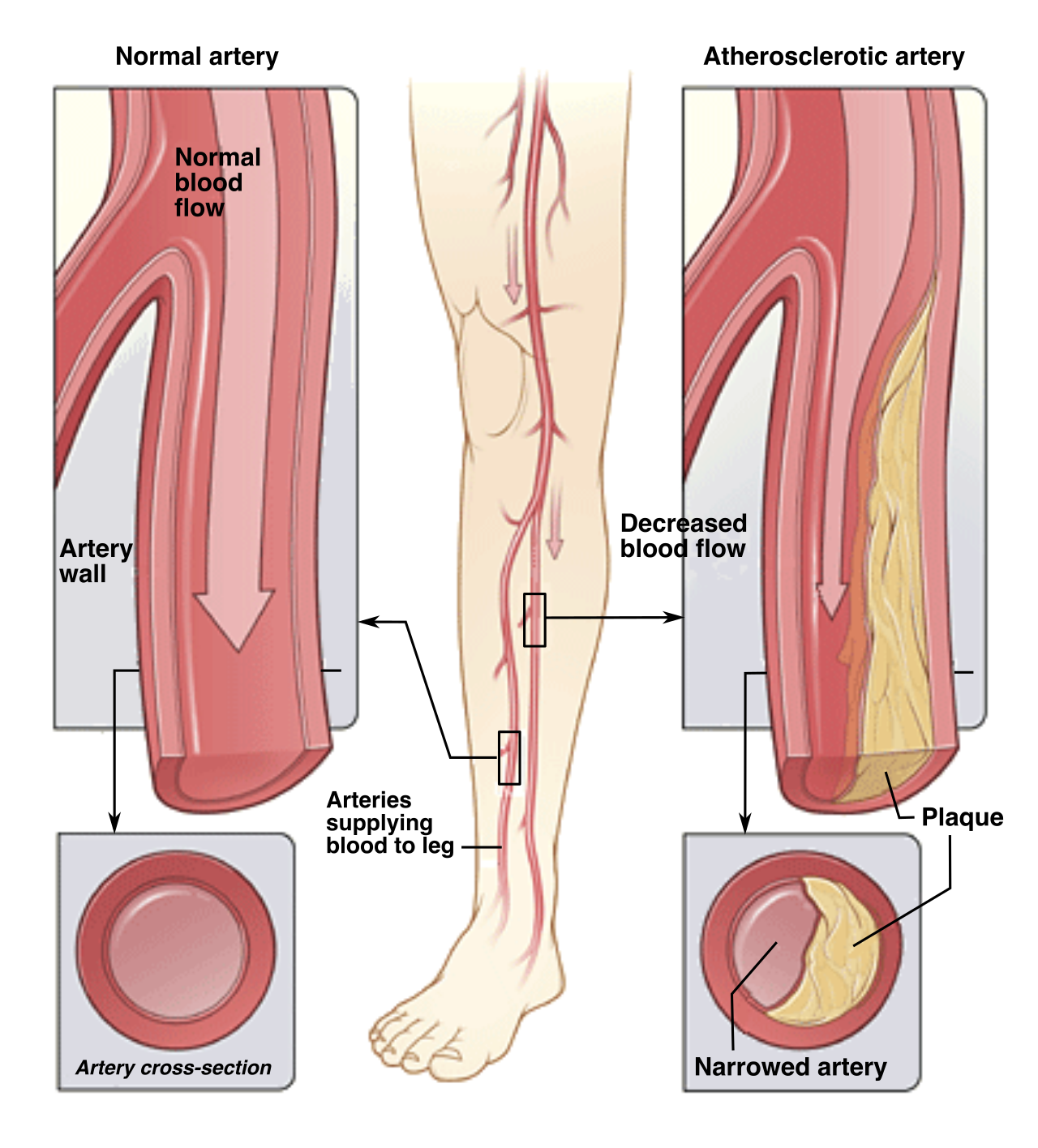 In Peripheral Arterial Disease (PAD), the arterial supply pipes become occluded by atherosclerotic plaque, severely restricting the flow of oxygenated blood to distal tissues.