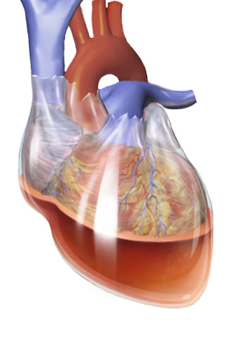 Hemopericardium leading to cardiac tamponade. The accumulation of blood in the rigid pericardial sac compresses the heart chambers, restricting ventricular filling and severely reducing cardiac output.
