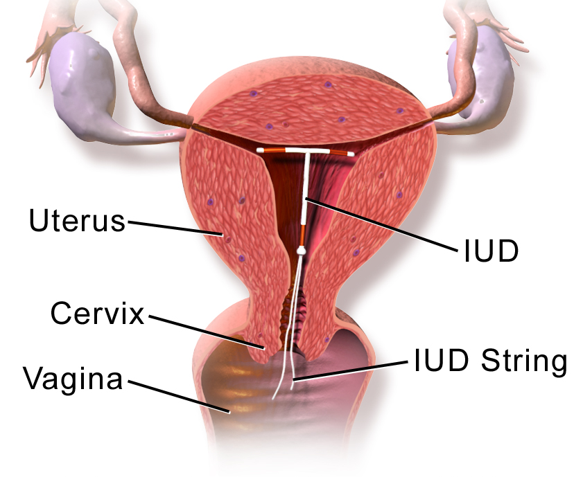 Proper placement of an intrauterine device (IUD) high within the uterine cavity.