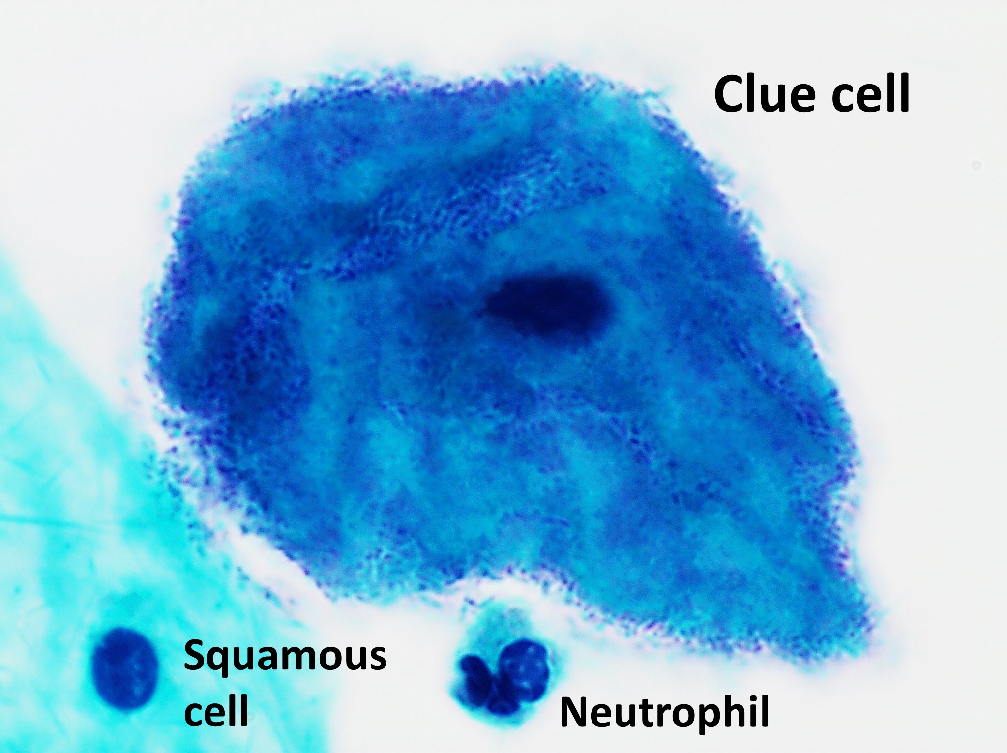 Microscopic view of a clue cell (center) heavily obscured by bacteria, a definitive diagnostic marker for Bacterial Vaginosis.