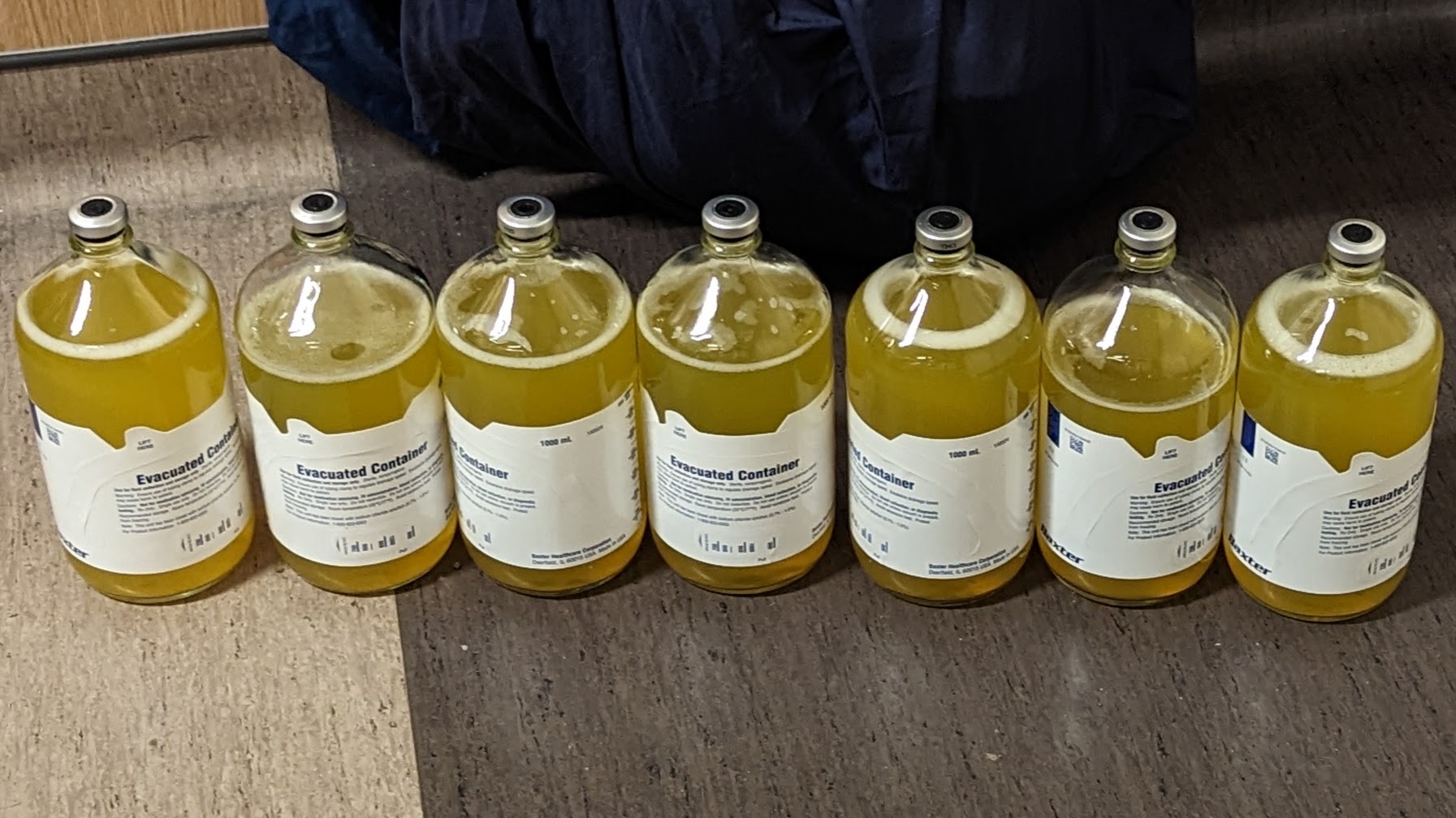 Seven liters of ascitic fluid drained during a paracentesis. Rapid removal of such massive volumes creates an abrupt drop in abdominal pressure, causing dangerous fluid shifts.