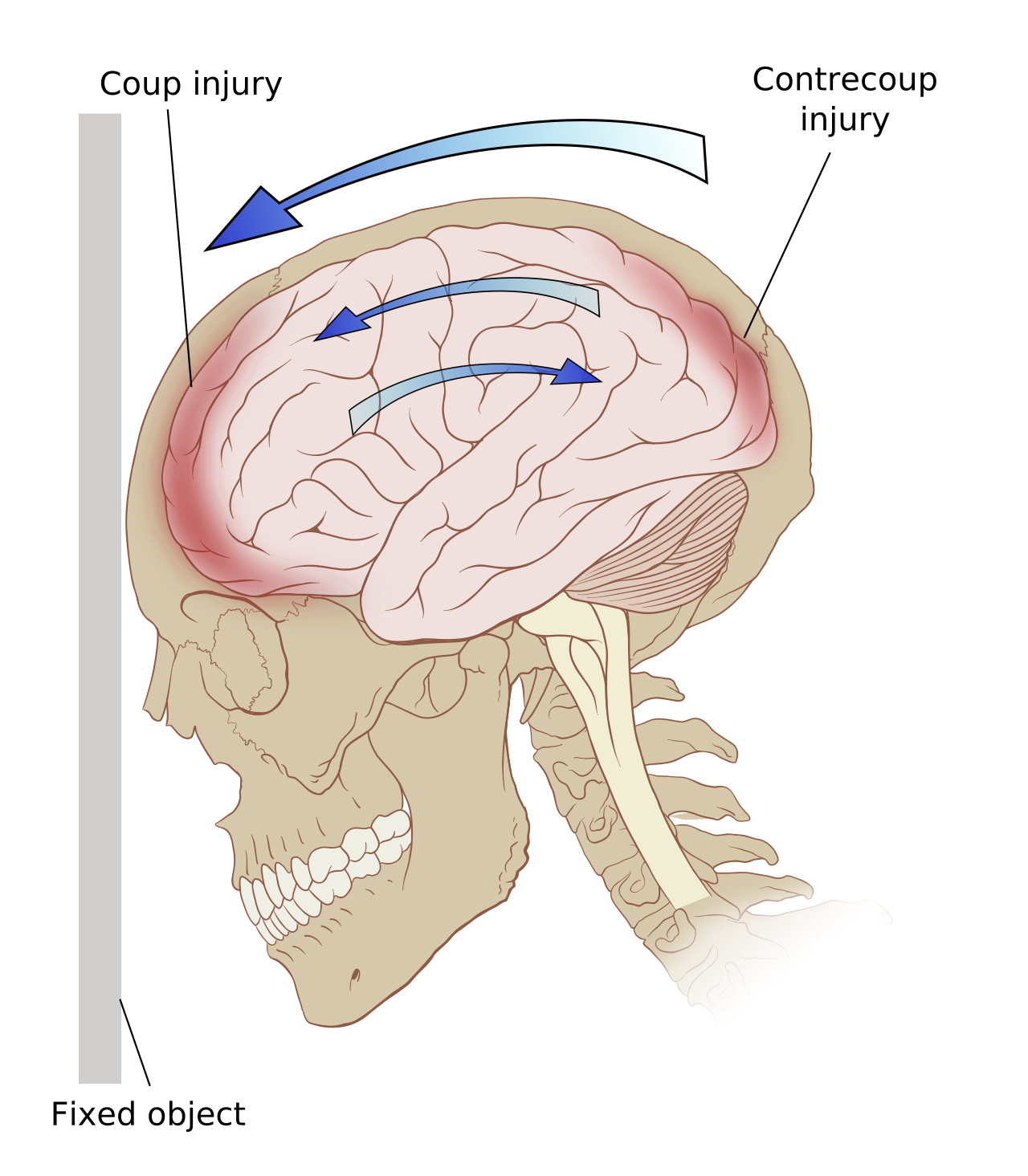 The coup-contrecoup phenomenon illustrates a closed head injury where external physical force causes the brain to ricochet within the skull, a prime mechanism of traumatic brain injury that damages neural networks.