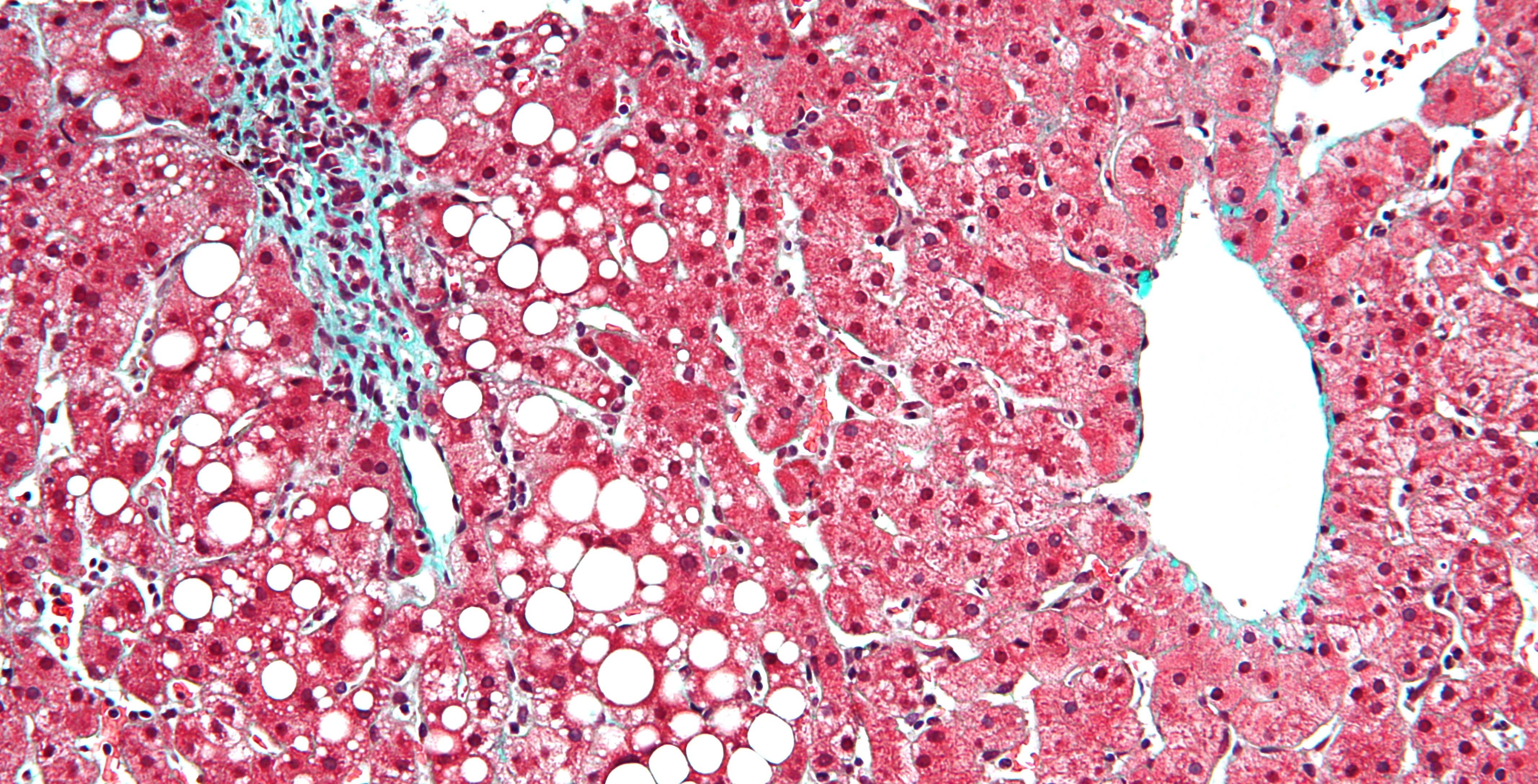 Micrograph showing hepatic steatosis (fatty liver), a known and serious complication of long-term TPN therapy occurring as the liver becomes overwhelmed processing the continuous, unnatural flow of macronutrients.