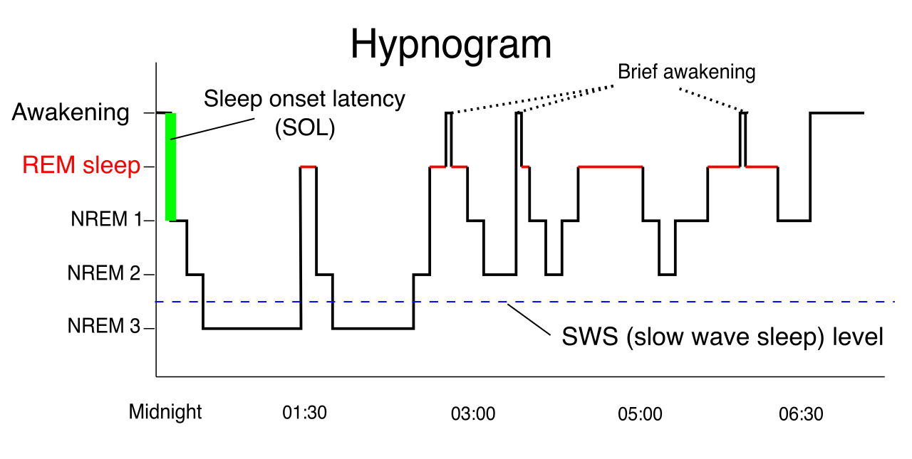 A normal sleep hypnogram illustrating the cyclical progression between NREM and REM sleep stages throughout the night.