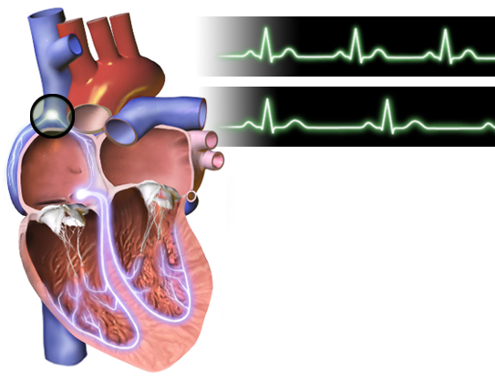 An illustration comparing a normal electrocardiogram (top) to one showing bradycardia (bottom). The prefix "brady-" alters the root "cardia" to describe the abnormally slow speed of the heart.