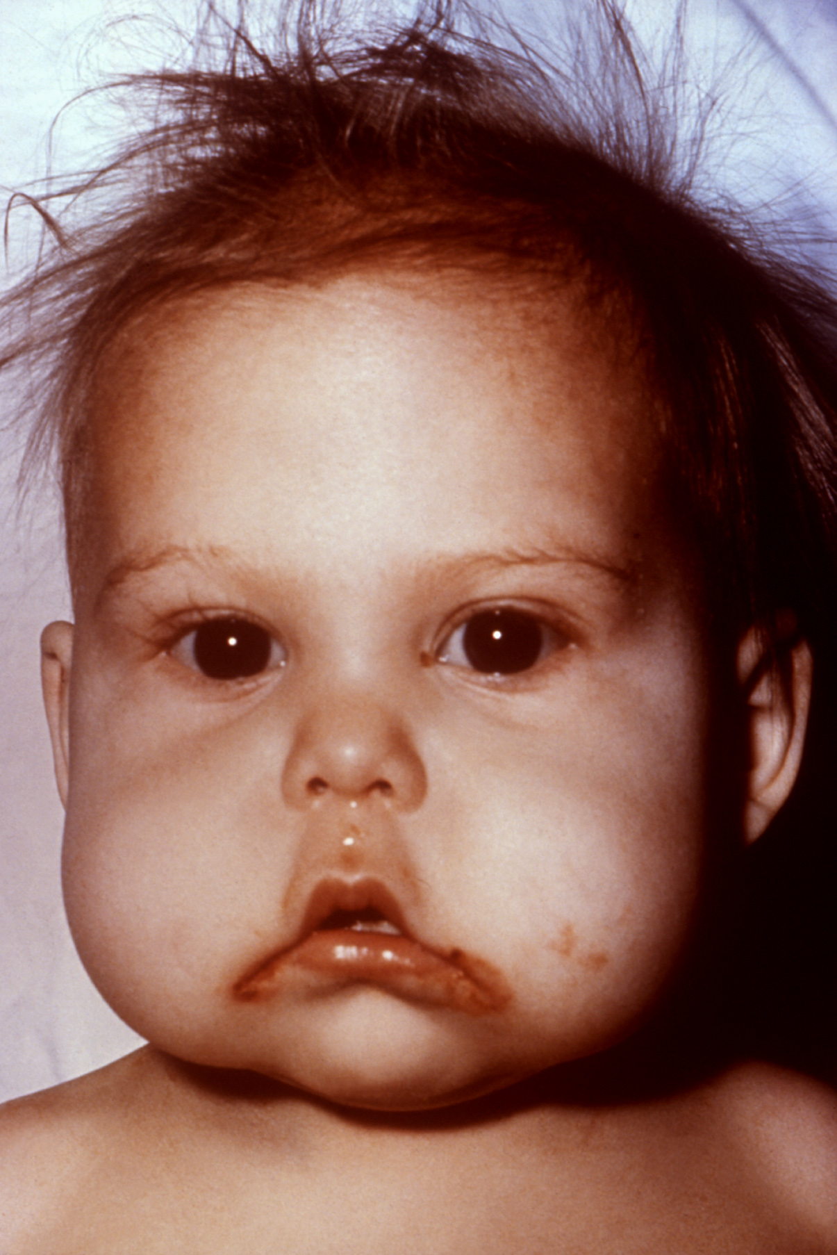 Severe malnutrition, such as the protein deficiency kwashiorkor seen here, is a major clinical indicator of child neglect when no underlying medical cause exists.