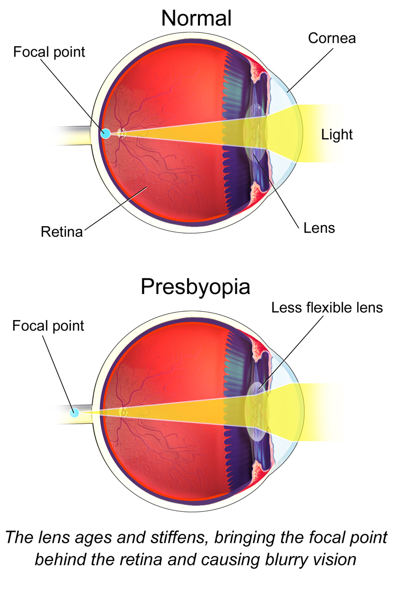Presbyopia occurs when the lens of the eye progressively loses its flexibility with age, making it difficult to focus on close objects. This is an expected physiological change that typically begins in middle adulthood.
