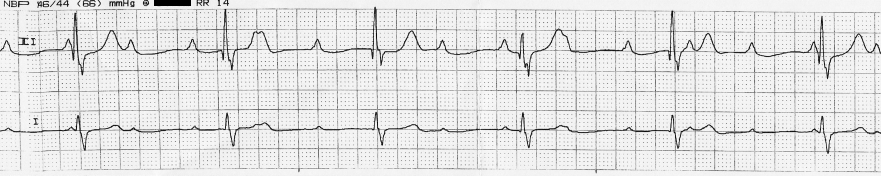 Electrocardiogram showing a third-degree (complete) atrioventricular block, where P waves are completely disconnected from the QRS complexes.