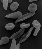 Scanning electron micrograph showing normal, round red blood cells alongside elongated, sickle-shaped cells. This devastating deformity is caused by a single incorrect amino acid that alters the 3D folding of the hemoglobin protein.