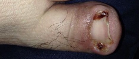 Purulent drainage (pus) and localized inflammation characteristic of an active tissue infection.