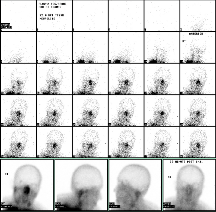 Radionuclide cerebral blood flow scan demonstrating an absence of intracranial perfusion ("hot-nose" sign), a confirmatory test utilized in the diagnosis of brain death.