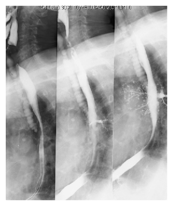 A barium swallow study demonstrating pulmonary aspiration. Preoperative fasting guidelines are strictly enforced to prevent gastric contents from entering the lungs while protective airway reflexes are suppressed by anesthesia.