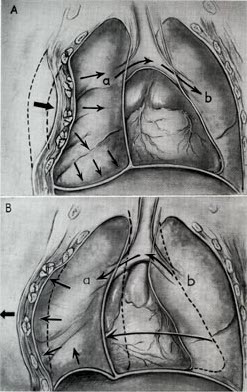 Mechanics of a flail chest. The detached segment of the rib cage moves paradoxically inward during inspiration and outward during expiration, severely compromising effective ventilation.