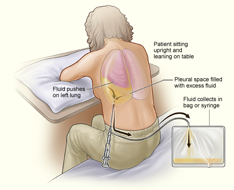 During a thoracentesis, a needle is inserted into the pleural space to drain excess fluid. A misguided puncture can inadvertently pierce the lung, causing a pneumothorax.