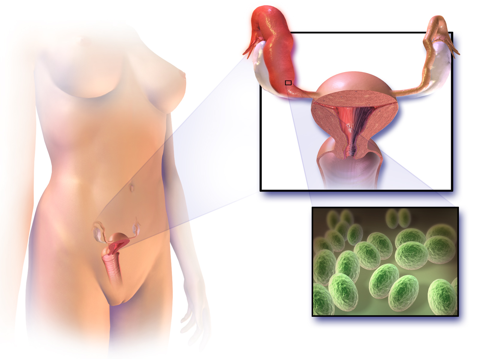 Pelvic inflammatory disease (PID) involves an ascending infection that moves from the vagina and cervix into the uterus, fallopian tubes, and potentially the ovaries.