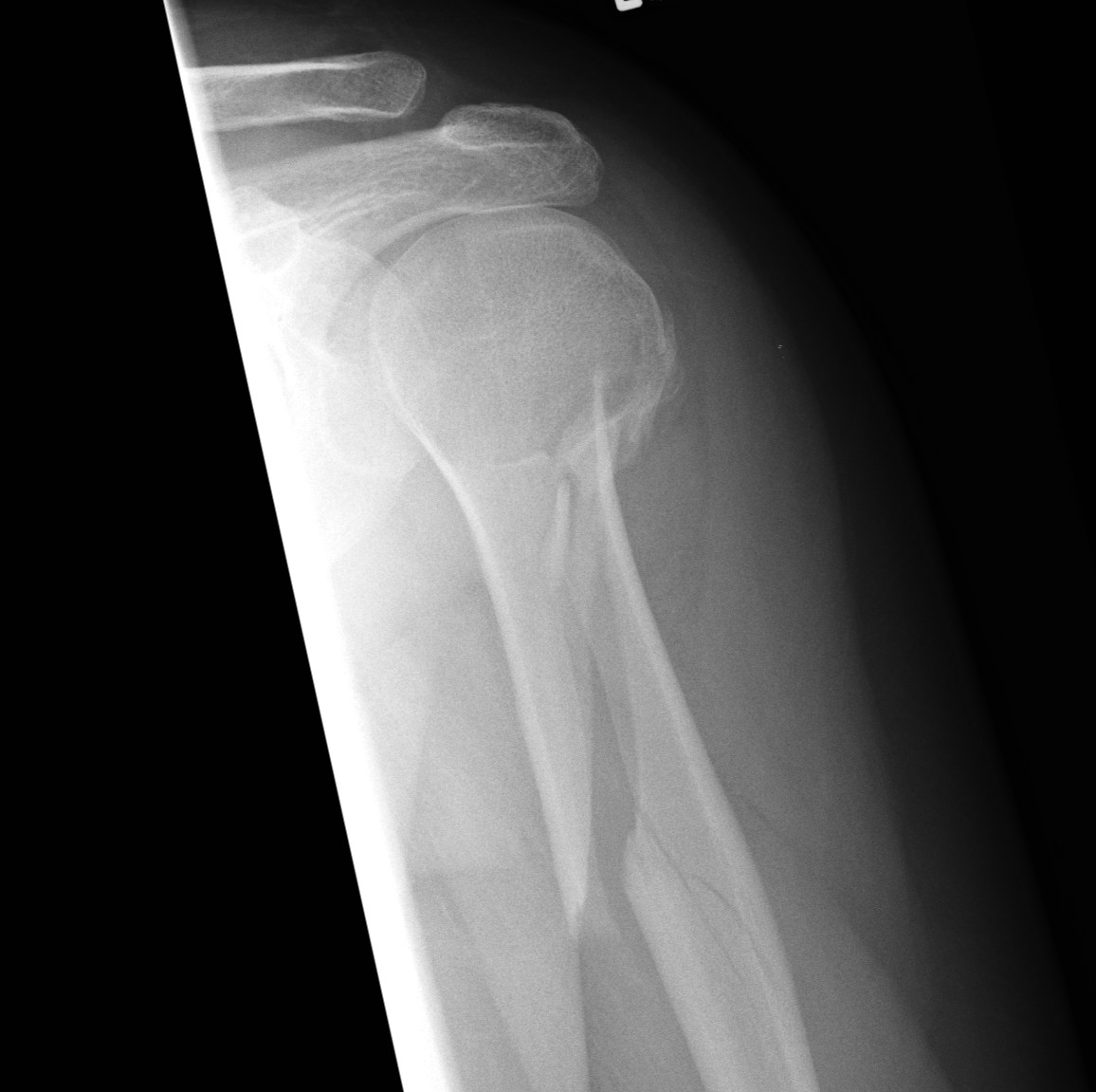 A radiograph showing a spiral fracture. In non-ambulatory infants, fractures caused by twisting forces are strong clinical indicators of physical abuse.