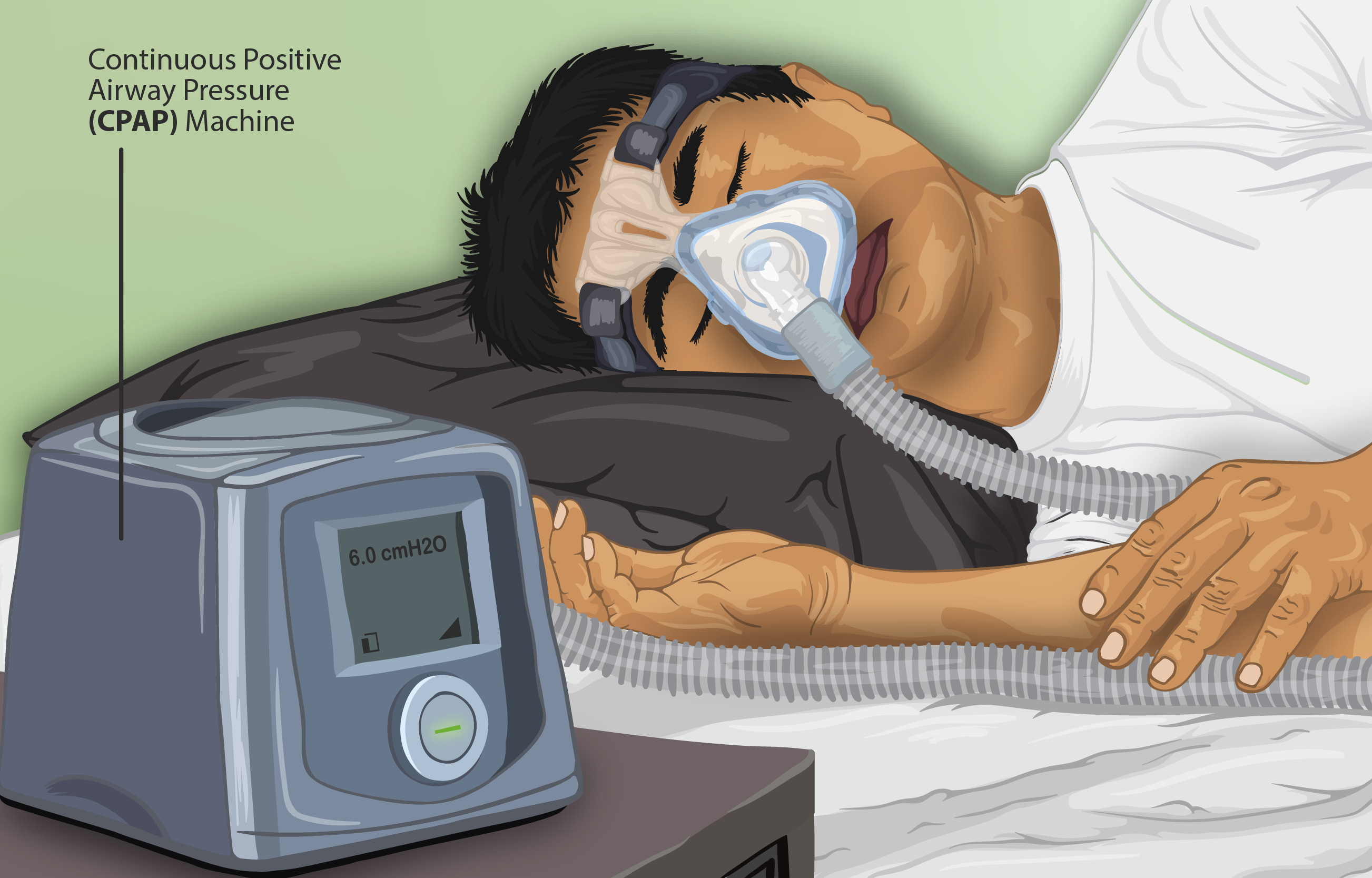 A continuous positive airway pressure (CPAP) device delivers a steady stream of pressurized air to mechanically splint the upper airway open during sleep.