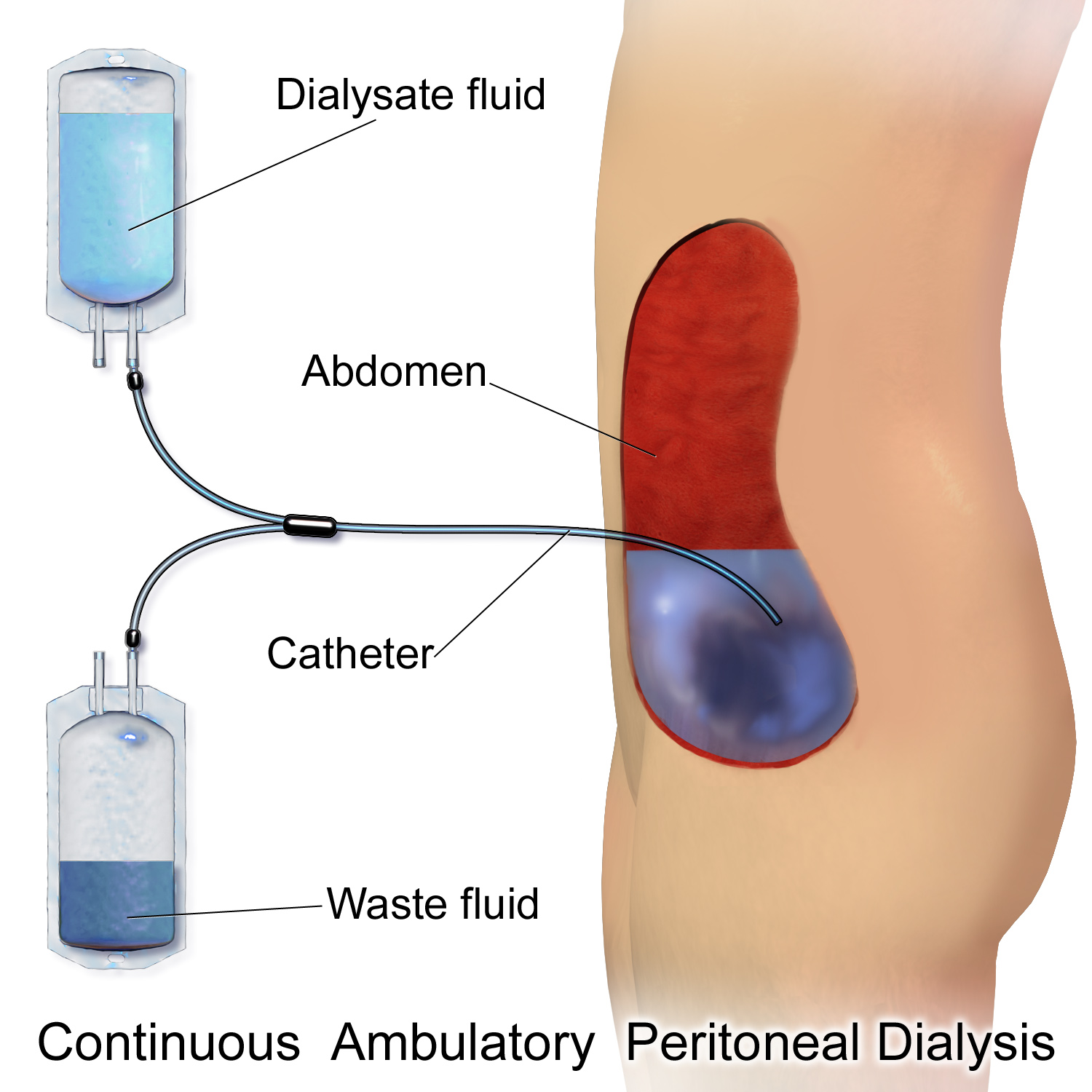 Continuous Ambulatory Peritoneal Dialysis (CAPD) is a complex procedure involving the infusion and drainage of dialysate into the abdominal cavity. A nurse must refuse this assignment if they lack the specific, documented competency to perform it safely.
