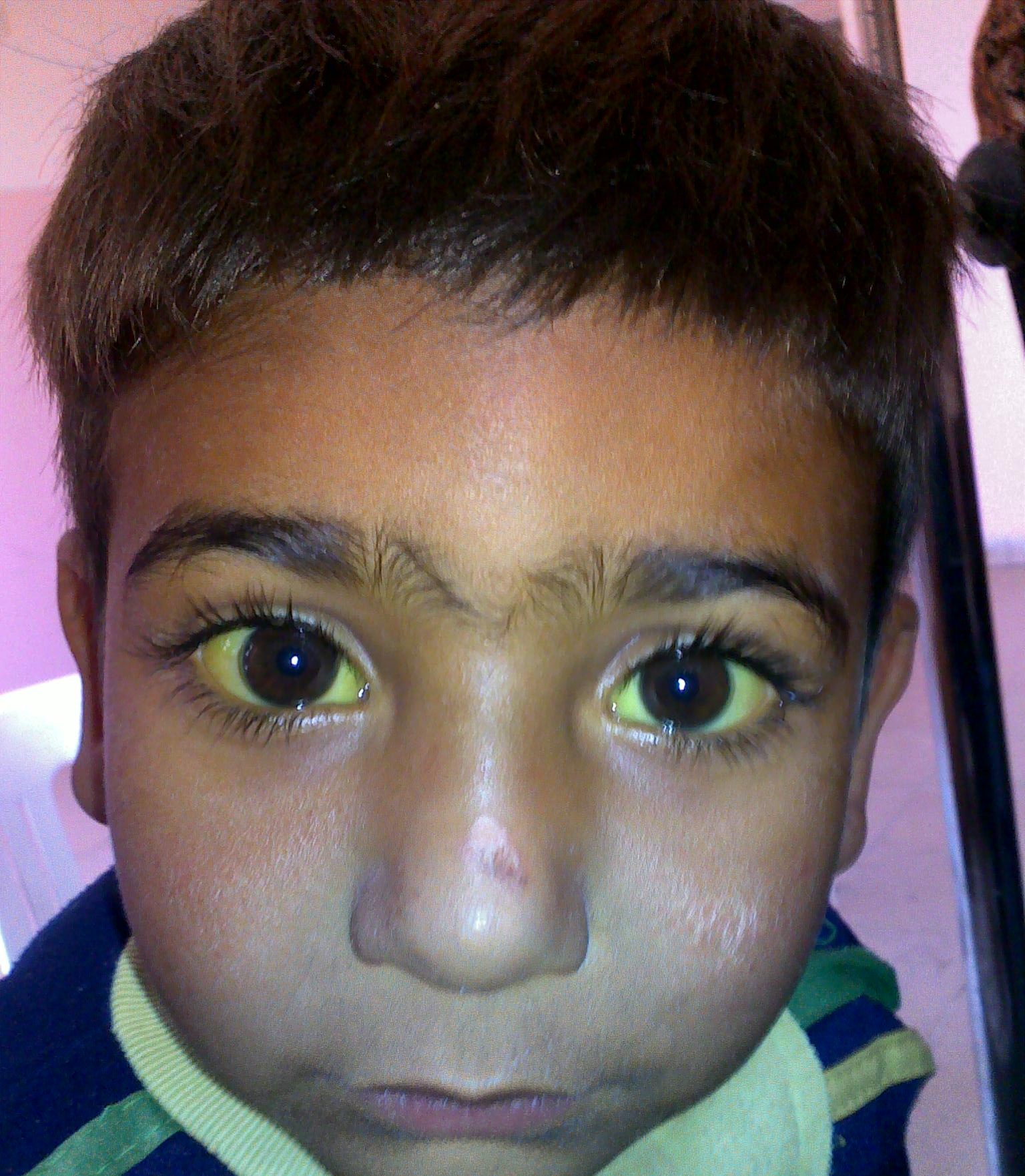 Jaundice in individuals with higher melanin levels is most reliably assessed by examining the sclera of the eyes or the hard palate.