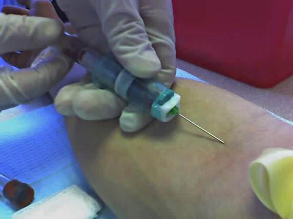 A standard venipuncture targeting the median cubital vein in the antecubital fossa, which is the preferred site for adults due to its size and superficial accessibility.