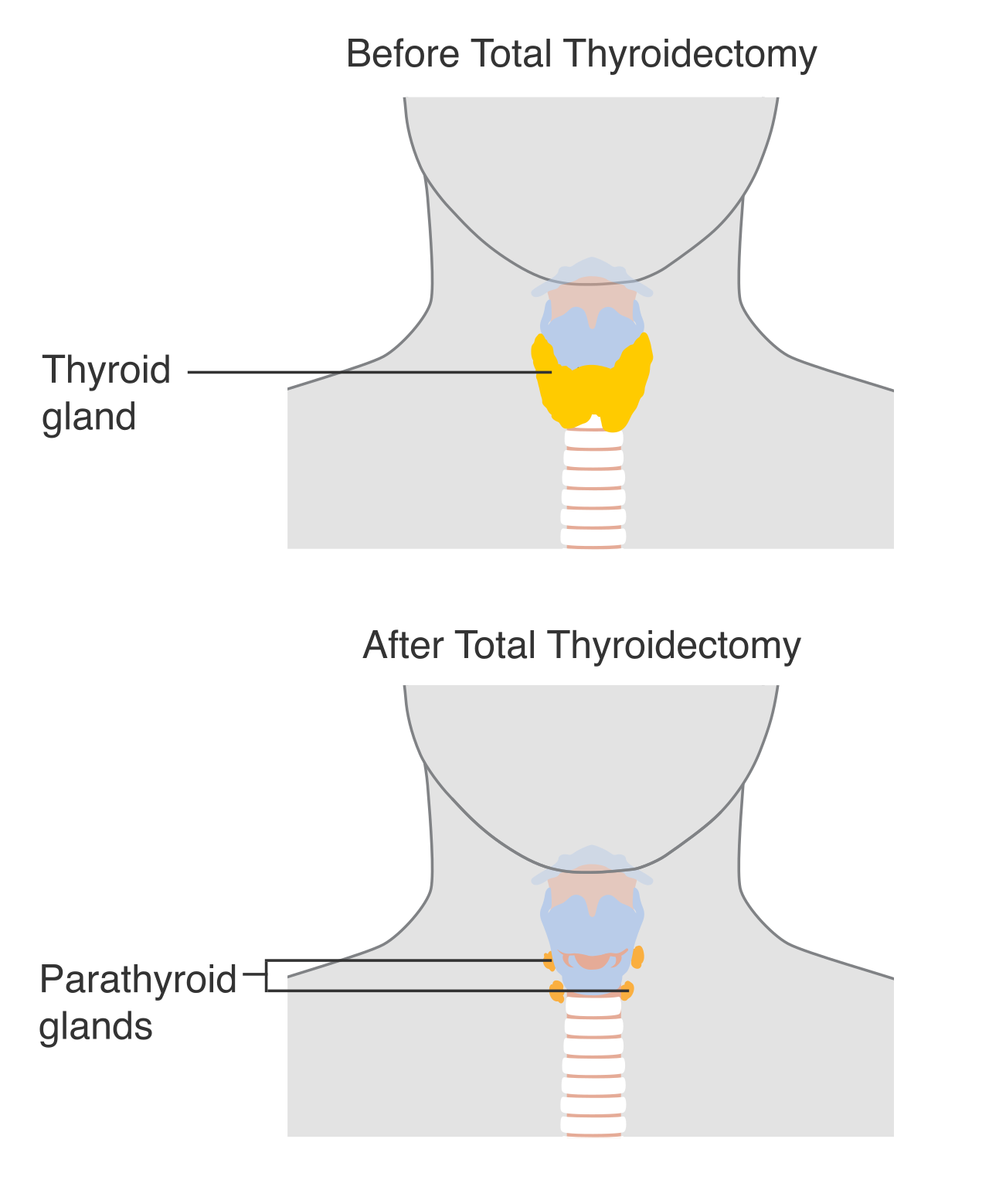 Diagram of a total thyroidectomy. If a patient asks specific medical questions regarding surgical risks, such as vocal cord paralysis, the nurse must pause the consent process and notify the provider.