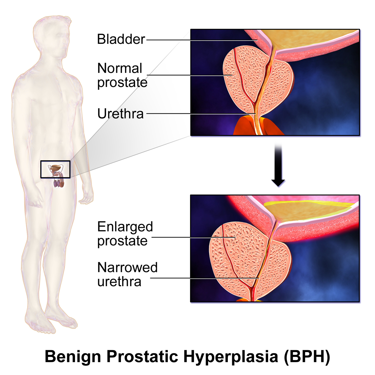 A cross-section showing benign prostatic hyperplasia (BPH). As the prostate gland enlarges with age, it compresses the urethra, causing bladder neck obstruction and contributing to increased urinary frequency and retention.