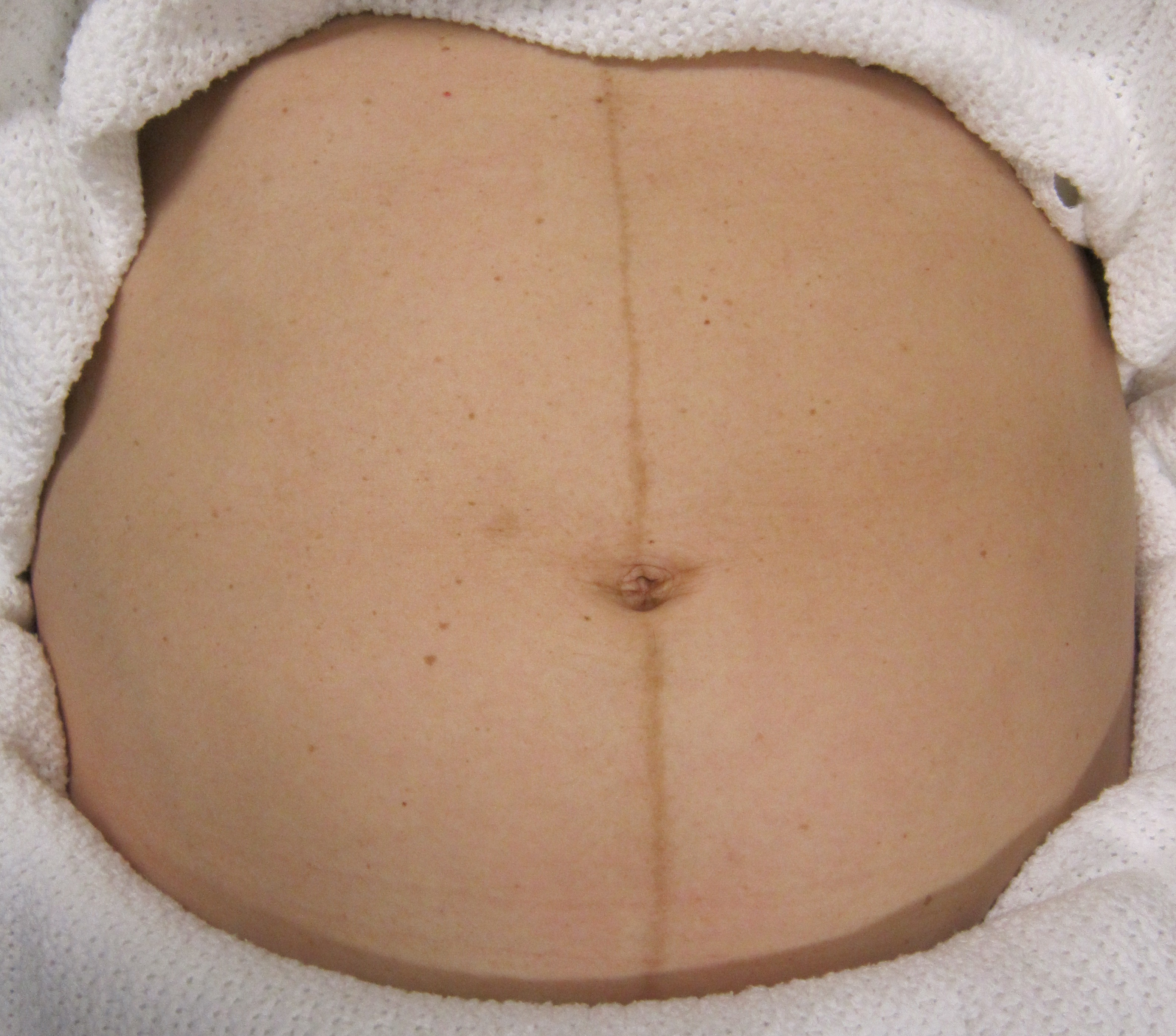 The linea nigra, a vertical line of hyperpigmentation on the abdomen, is a common pregnancy-induced dermatological change resulting from endocrine shifts.