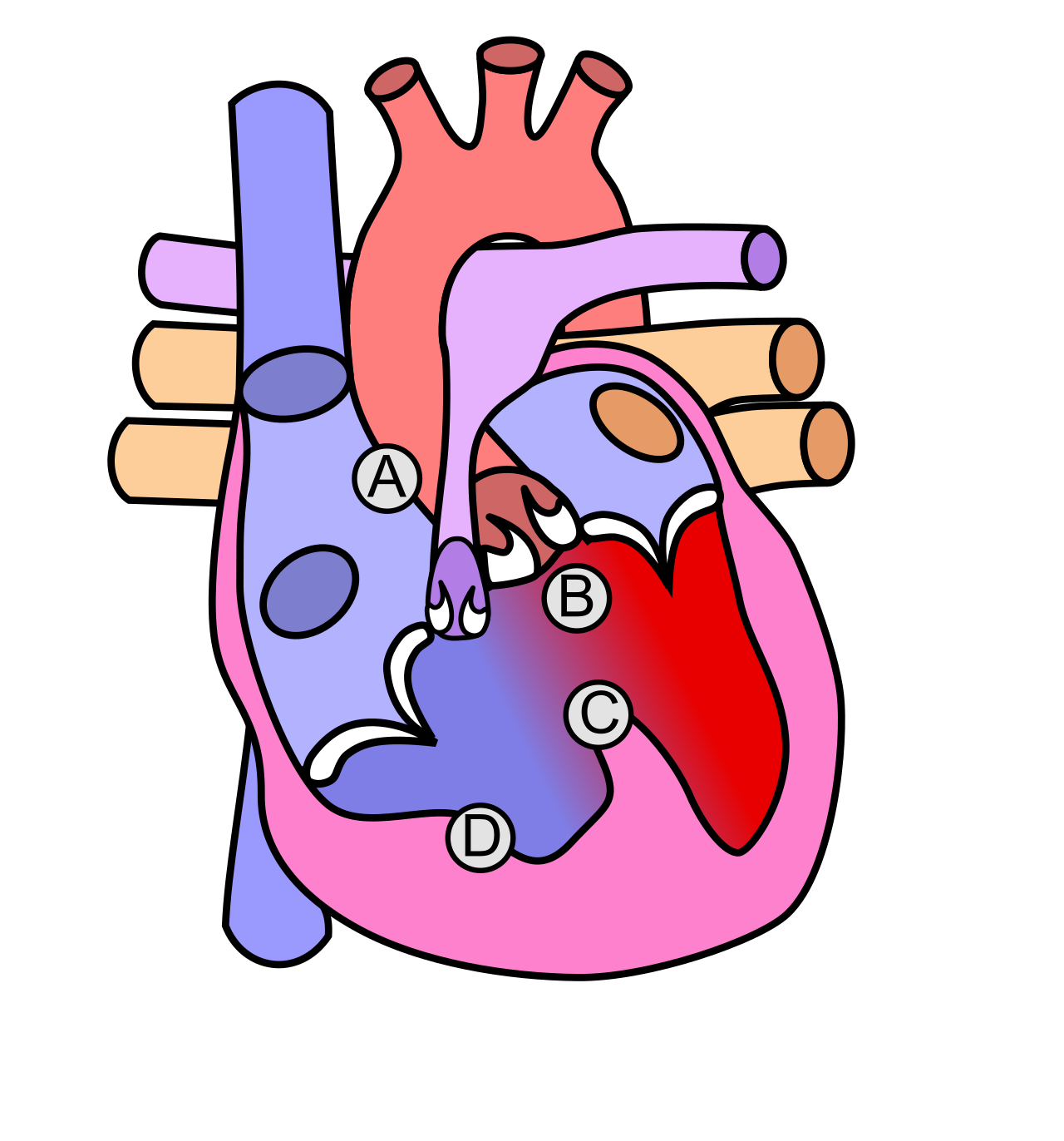 The four structural defects defining Tetralogy of Fallot: (A) pulmonary stenosis, (B) overriding aorta, (C) ventricular septal defect, and (D) right ventricular hypertrophy.