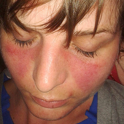 Just as a characteristic malar or "butterfly" rash provides a visual context clue for diagnosing Lupus in a patient, authors leave textual context clues around unfamiliar words to explicitly reveal their definitions.