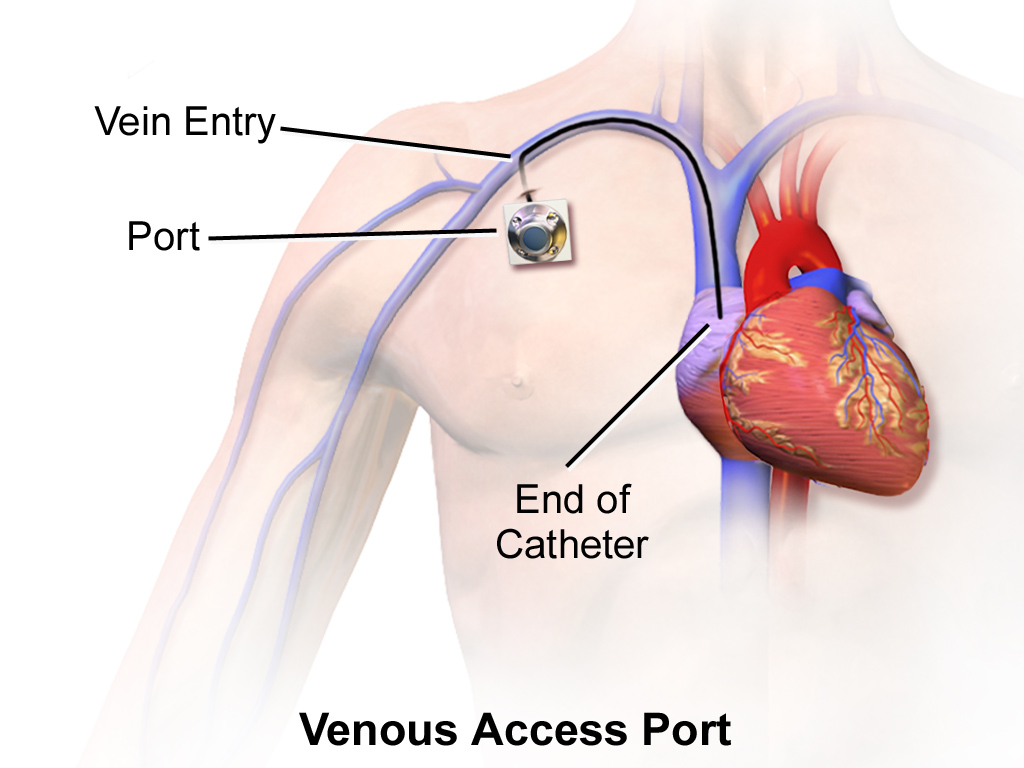 An implanted vascular access port resides entirely under the skin and connects to the central circulation, requiring a specialized non-coring Huber needle for access.
